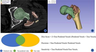 Accuracy and reliability analysis of a machine learning based segmentation tool for intertrochanteric femoral fracture CT